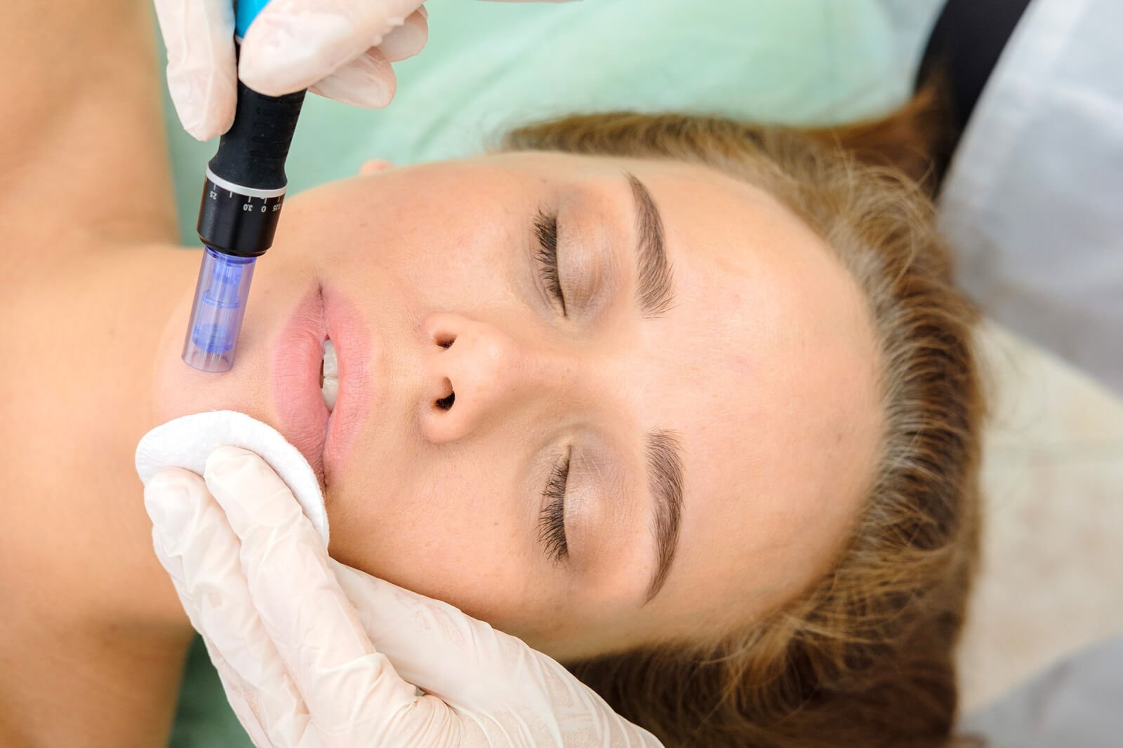 Mesoterapia